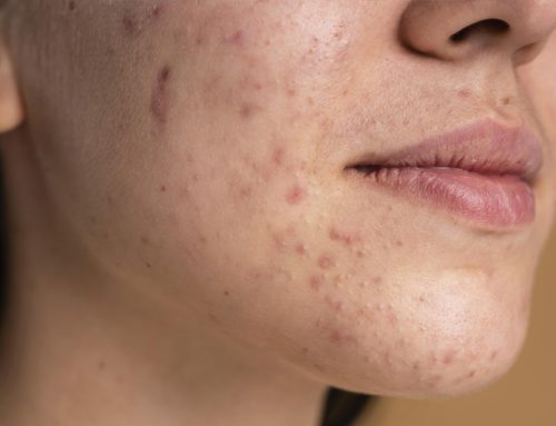 Acné: Tipos, causas y tratamientos efectivos