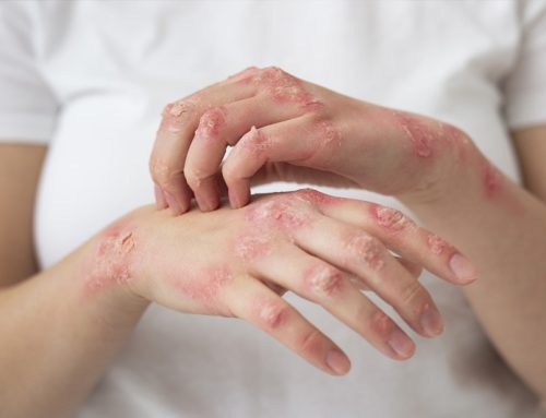 Psoriasis: Causas, síntomas y tratamientos efectivos