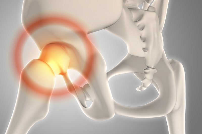 Artrosis de Cadera: Tratamientos