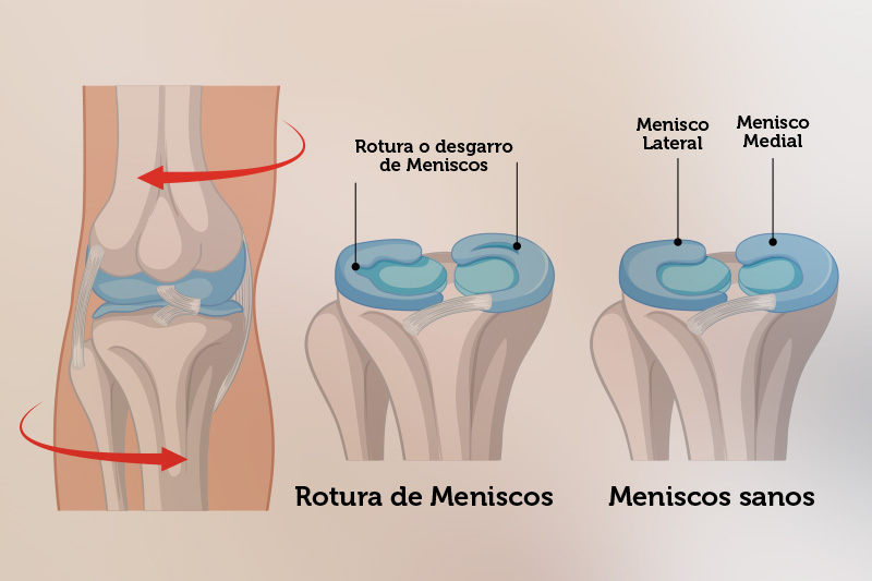 Diagnóstico de Lesión de Meniscos
