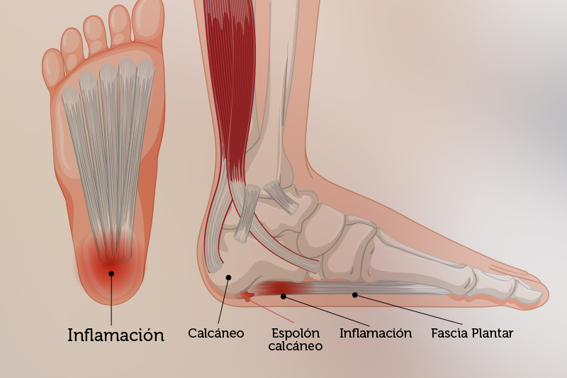 Tratamiento contra espolon Calcaneo