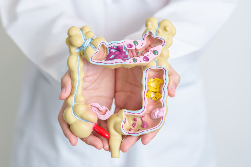 Test qFIT para la detección temprana de cáncer colorrectal