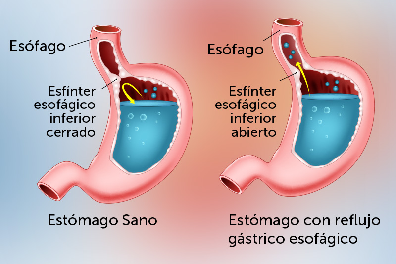 Diagnóstico de reflujo gastroesofágico