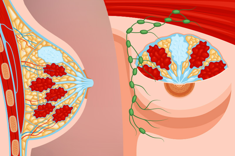 Cómo se diagnostica un fibroadenoma