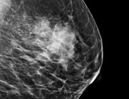 ¿Qué es un fibroadenoma mamario?
