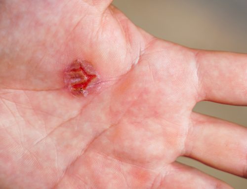 ¿Qué son las infecciones de piel y tejidos blandos?