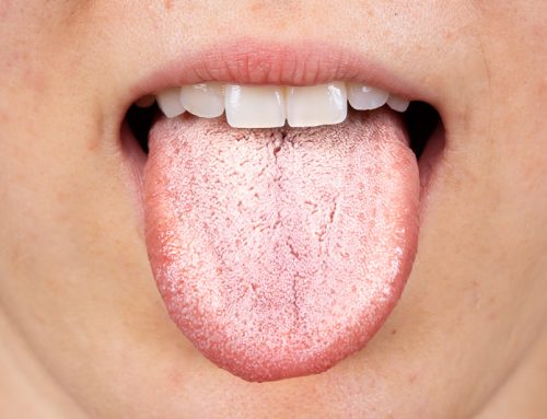 Síndrome de Sjögren: Síntomas y Tratamiento