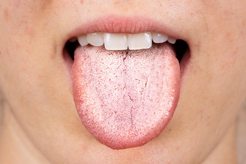 Tratamiento para Sjogren